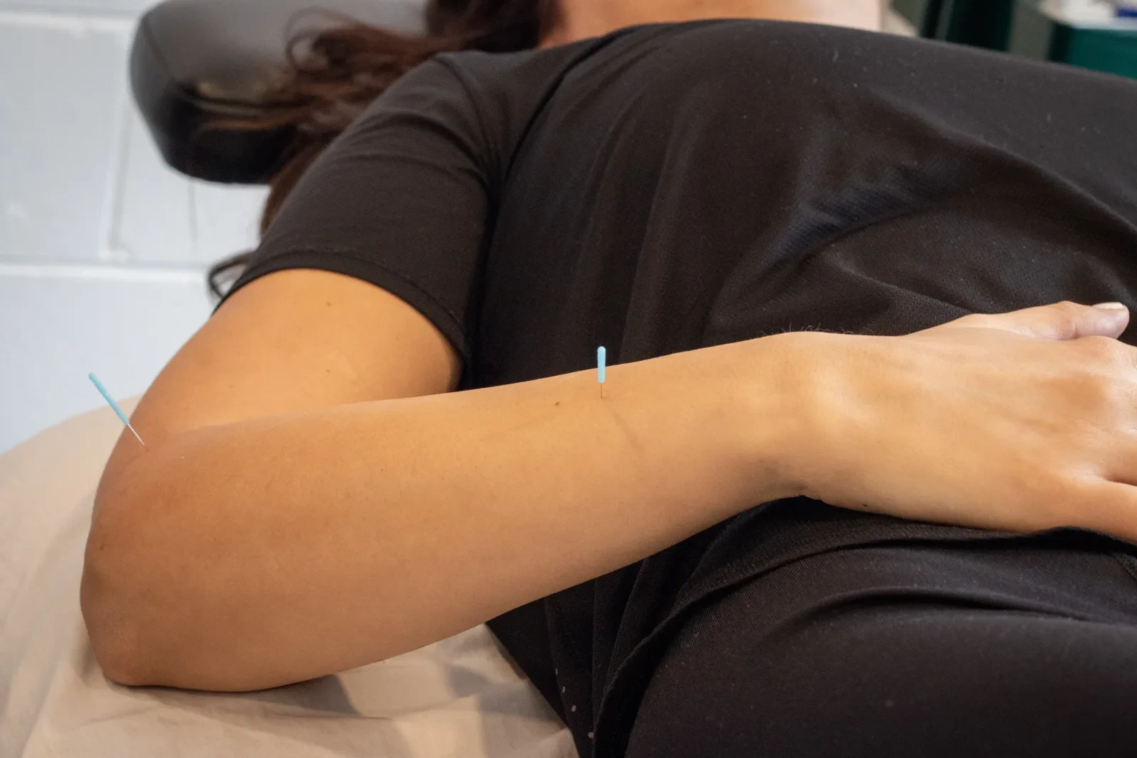 A patient resting with acupuncture needles placed in the forearm during treatment.